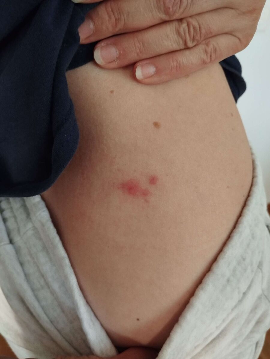 bettwanzen_bekaempfen